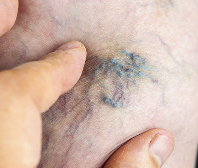 labial varicose veins