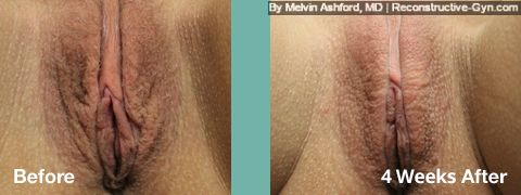 Vulvar Lightening and Tightening: Before and After.