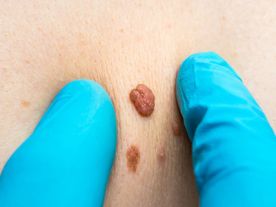 Anal Skin Tag Removal